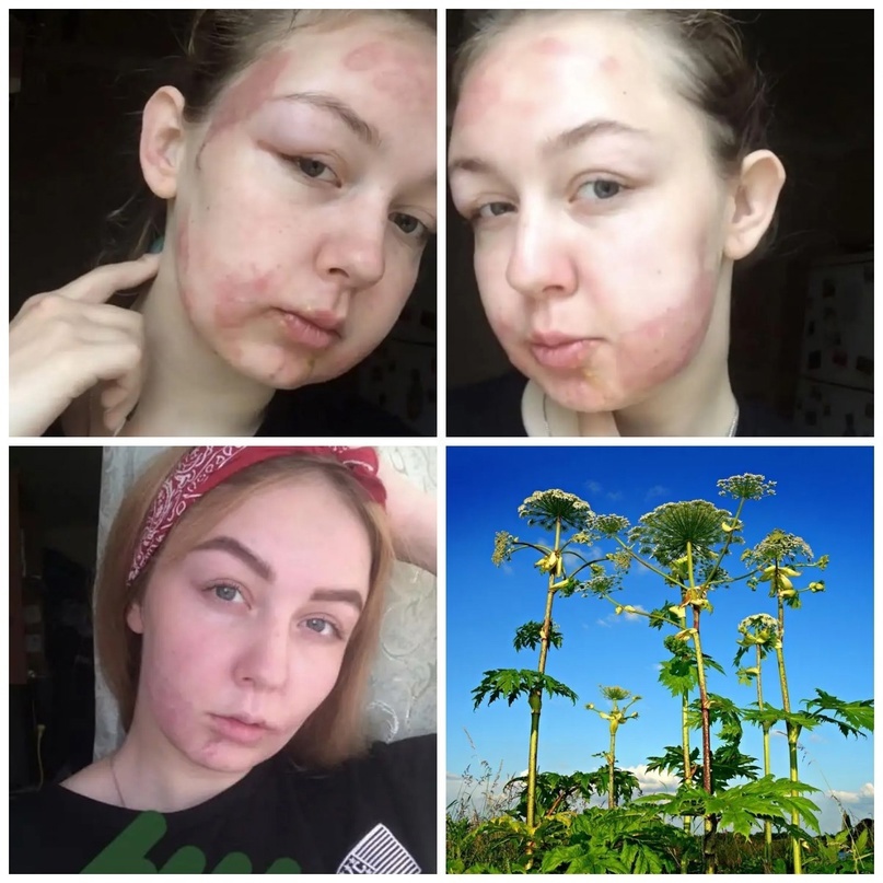 J0KWXHQC1iI - Ожоги от борщевика могут быть довольно болезненными и вызывать раздражение на коже.